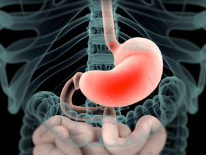 Acid reflux shown in xray view of intestines. Stomach is red.