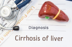 Anatomical 3D model of human liver is near stethoscope, results of laboratory tests of liver function and printed on notepad diagnosis of Cirrhosis of liver