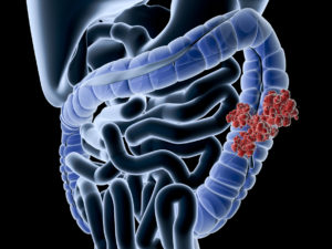 Digital medical illustration: Perspective x-ray view of human colon with Colon Cancer
