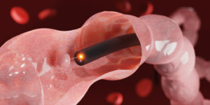 Colon cancer screening