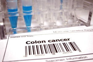 colon Cancer genetic testing